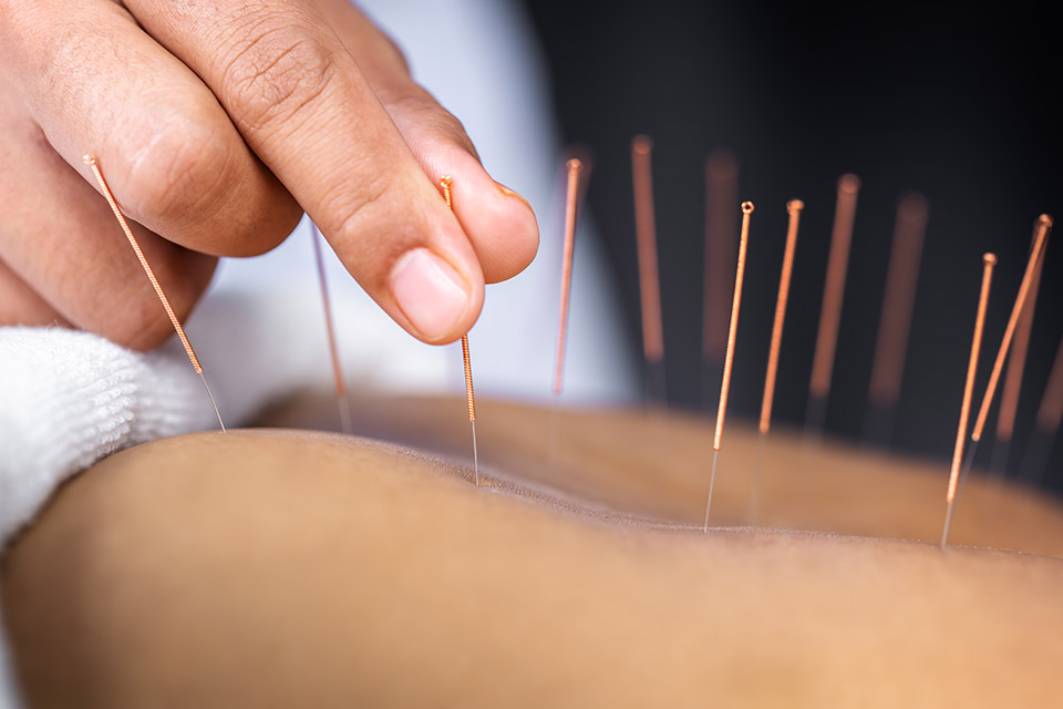 acupuncture